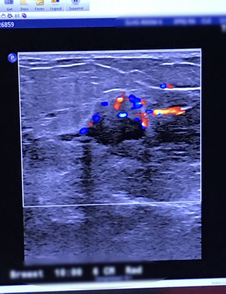 ultrasound of invasive ductal carcinoma